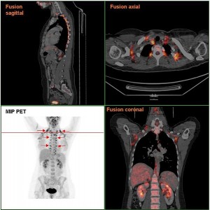 601px-Brownfat_PETCT