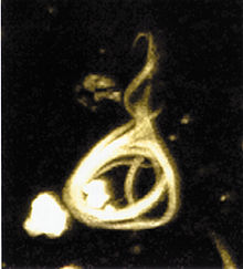 Neurofibrillary tangle.